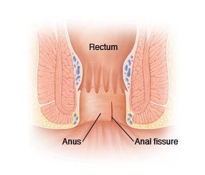 écartement doux des plis de l'anus afin de faire apparaître la fissure anale