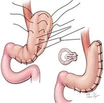 schéma explicatif de la plicature gastrique en Tunisie