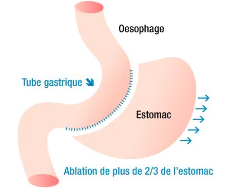 Schéma explicatif de la sleeve Gastrectomie en Tunisie